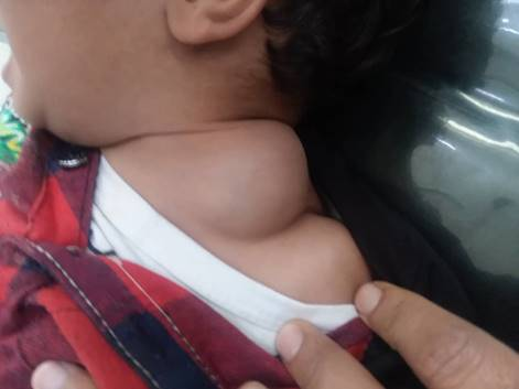 جراحة الأورام الدموية الولادية